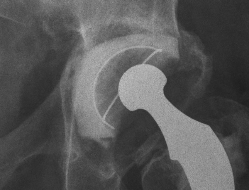 Revision Acetabulum Paprosky Type IIC